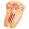 IUD PLACEMENT TRAINING SIMULATOR (SOFT)